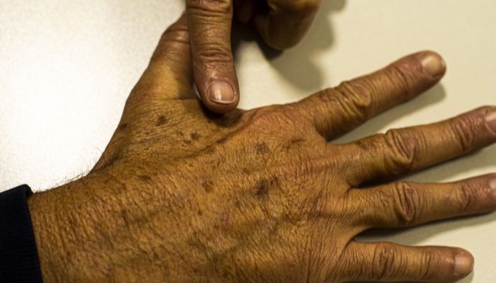 cancer_de_pele_melanoma20220520_0621.jpg